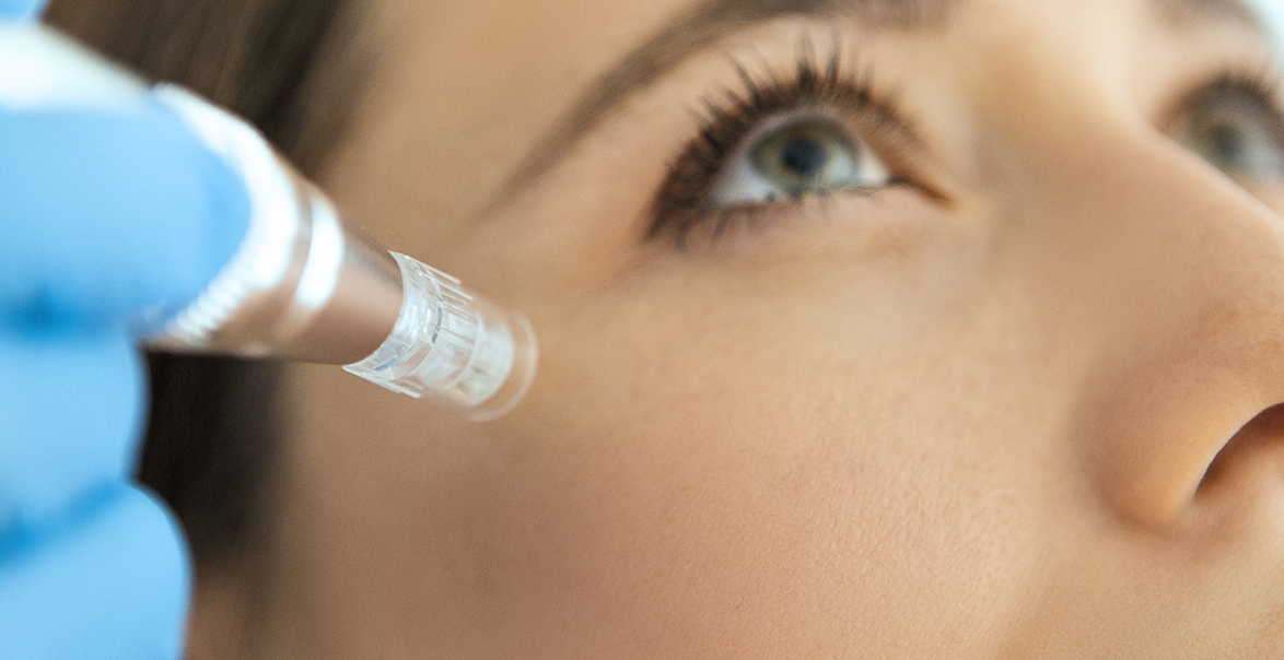 Discover Everything You Need to Know About Microneedling